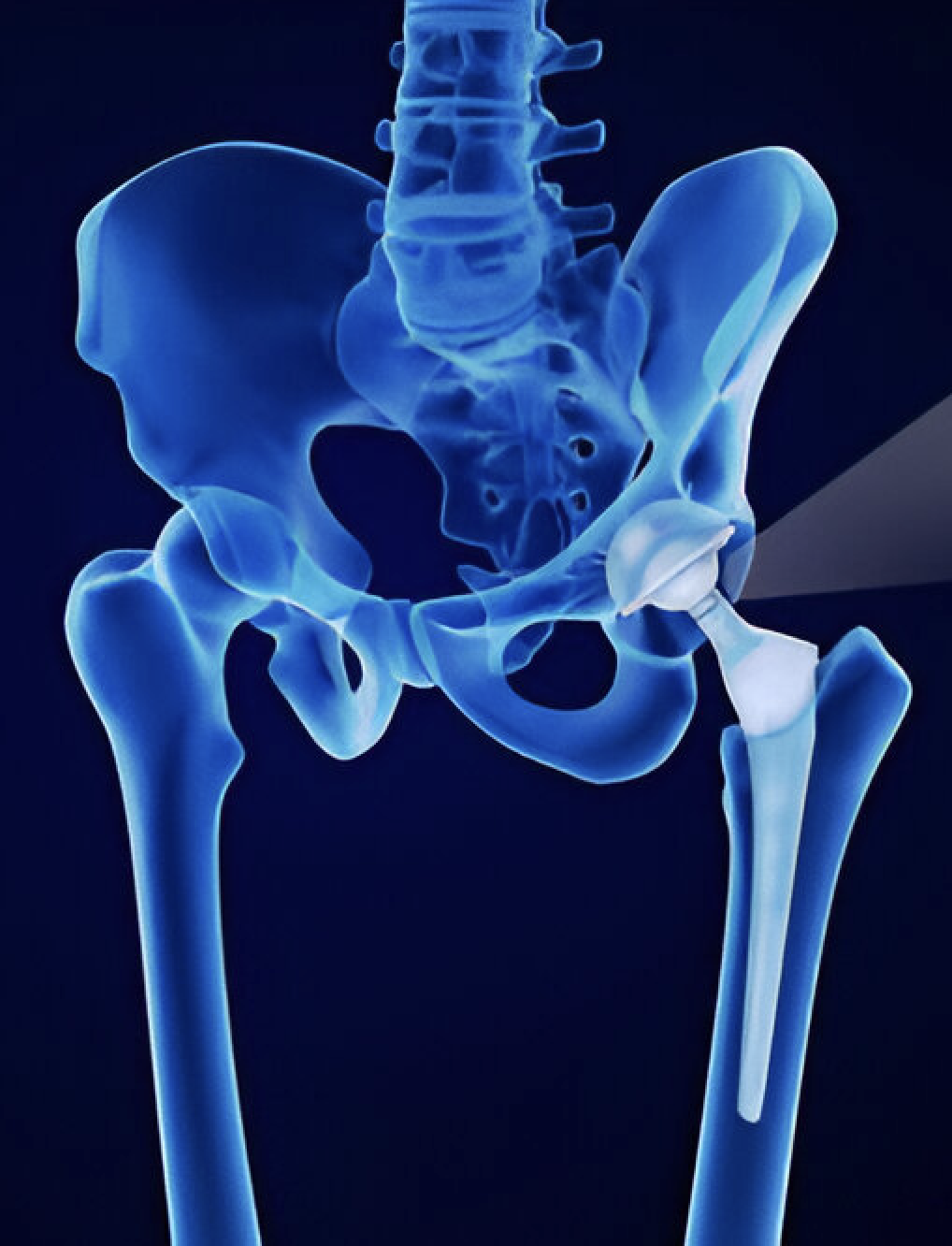 Total Hip Replacement Surgery Goyal Hospital Kosi Kalan