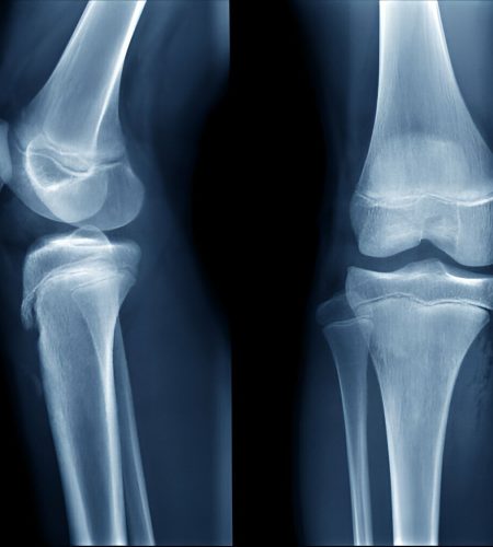 Trauma and fracture surgeries Trauma and fracture surgeries